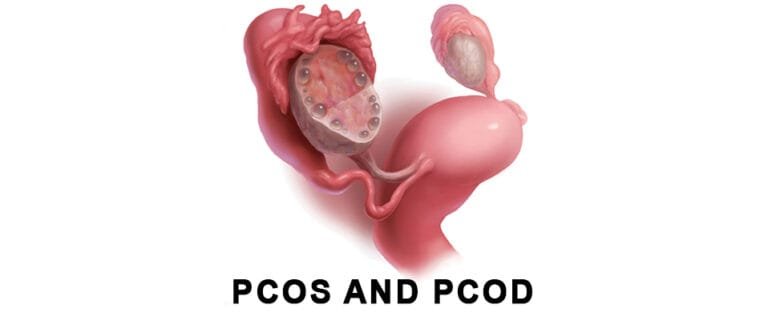 BadlapurCity | PCOD आणि PCOS: स्त्रियांनी ओळखायलाच हवेले हे दोन शत्रू!